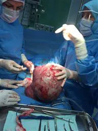 خارج کردن تومور 8 کیلویی از شکم بیمار  34 ساله 